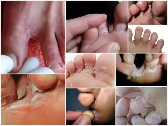 simptomi gljivica između nožnih prstiju slika 1