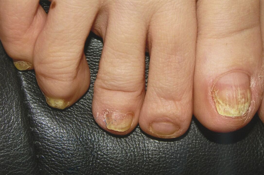 Gljivice na noktima nogu