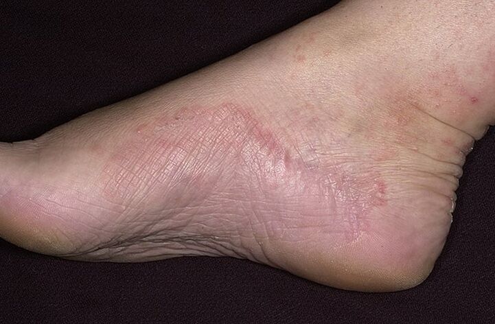 Gljivična infekcija stopala