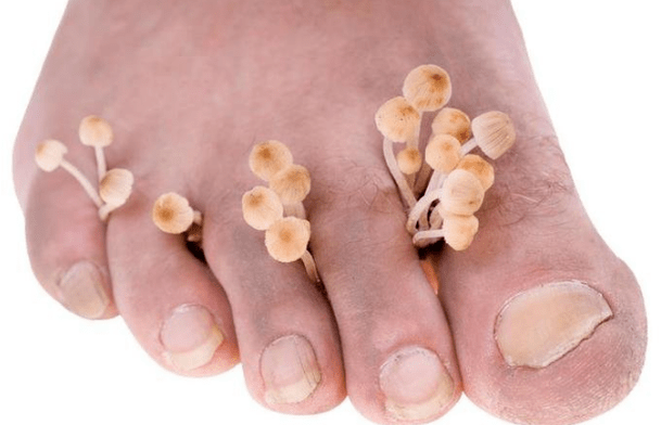 Gljivična infekcija stopala